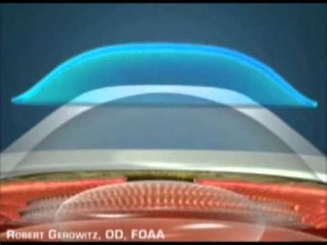 How Orthokeratology Works - YouTube