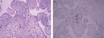 Cytomegalovirus Infection During Pregnancy - Mononucleosis