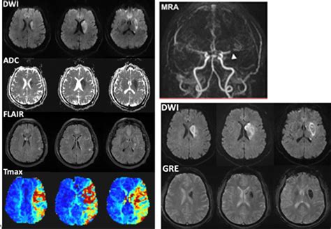 Acute Ischemic Stroke | Radiology Key