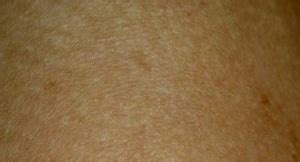 Chlorine Rash - Pictures, Treatment, Symptoms, Causes