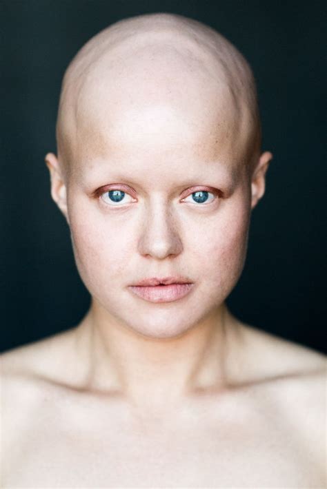 Women With Alopecia Captured In Beautiful Pictures Challenging Gender Stereotypes - Art-Sheep