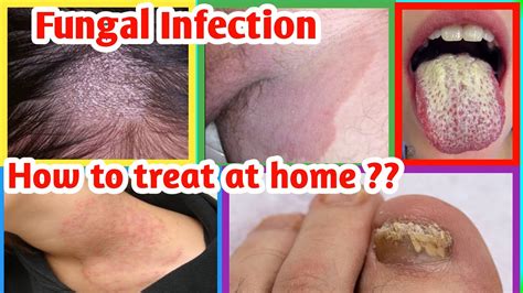 Fungal infection Treatment | Fungal infection in Private Parts | Fungal infection on Skin ...