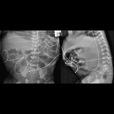 Prune Belly Syndrome | Pediatric Radiology Reference Article ...