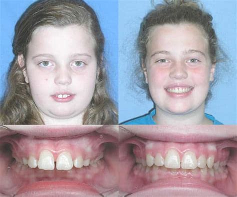 Braces for Overbite - Full Pro Guide 2023 - BracesBoss