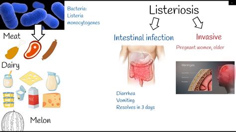 listeriosis - Symptoms and treatment. Listeria monocytogenes. - YouTube