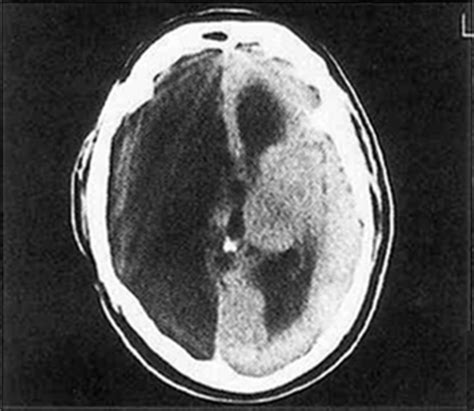 Hemispherectomy for intractable seizures: long-term results in 17 ...