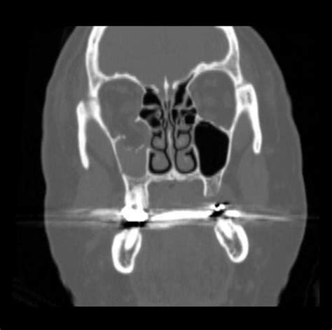 Blowout fracture - wikidoc