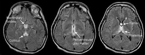 [PDF] Korsakoff’s syndrome: a critical review | Semantic Scholar