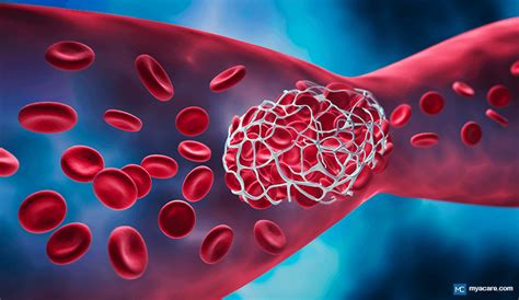 RISKY BLOOD CLOTS - LEARN WHEN BLOOD THINNERS ARE USEFUL | Mya Care