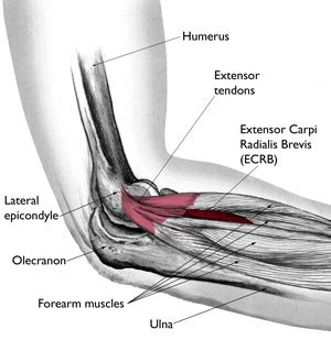 The F.A.S.T. Cure for Tennis Elbow (Lateral Epicondylitis) - Covenant ...