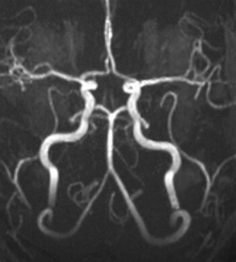 Circle Of Willis Mri