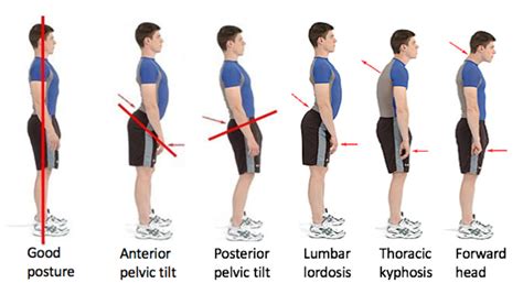 Pectus Posture | Pectus Clinic