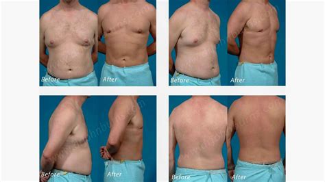 Liposuction Before And After Men