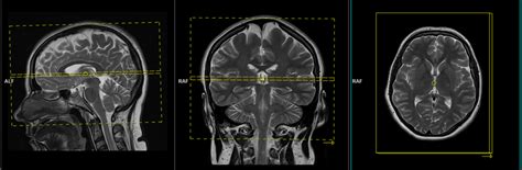 Pituitary MRI Protocols, Planing and Indications | Pituitary Dynamic