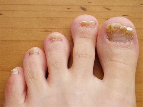 Toenail Fungus – Causes, Treatment and Prevention – Health Tips Ever Magazine