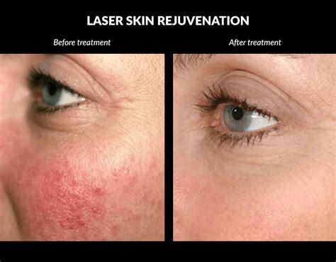 The Difference Between Laser Skin Rejuvenation & Skin Tightening