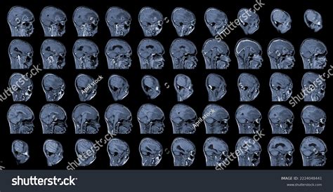 MRI Brain Axial views .to evaluate brain tumor. - Royalty Free Stock ...