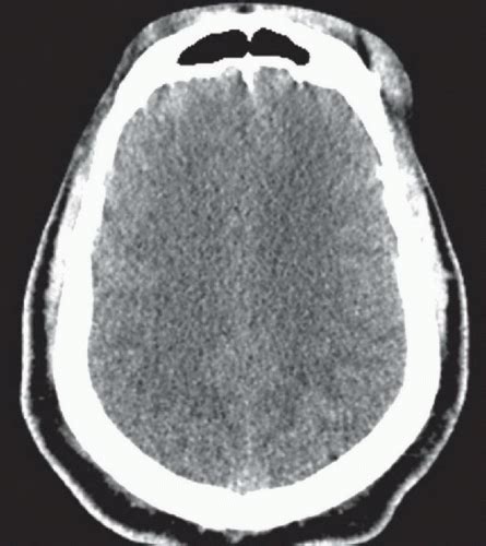 Diffuse Axonal Injury | Radiology Key