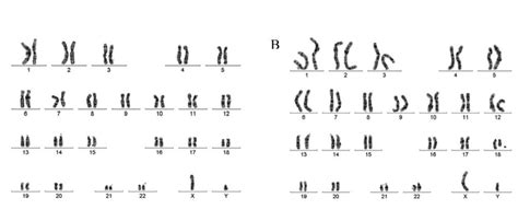 Abnormal Karyotype Vs Normal Karyotype