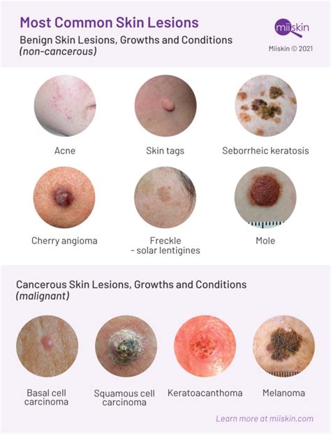 Skin Lesions: Types, Pictures & Prevention