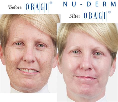 Obagi® Before and After Pictures – Micki Ly M.D. Maui Dermatologist