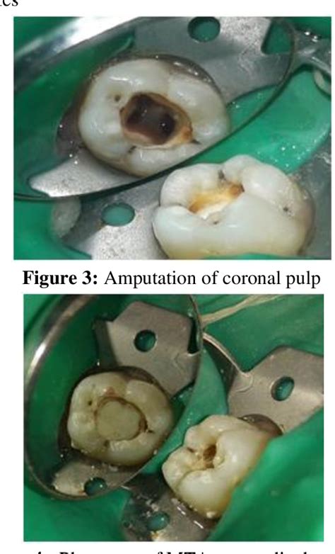 Figure 3 from Mineral Trioxide Aggregate Pulpotomy for Permanent Molars with Clinical Signs ...