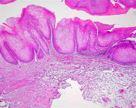 Proliferative Verrucous Leukoplakia Histology