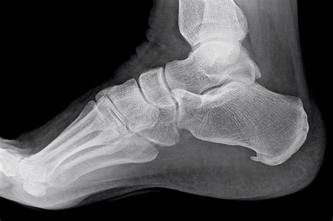 Plantar Calcaneal (Heel) Spurs - Sports Podiatry Info