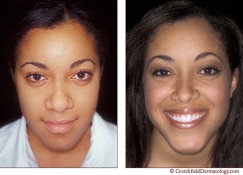 proactiv before and after | steadypaceblog