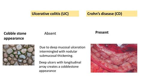 ULCERATIVE COLITIS vs CROHNS DISEASE - Pathology Made Simple