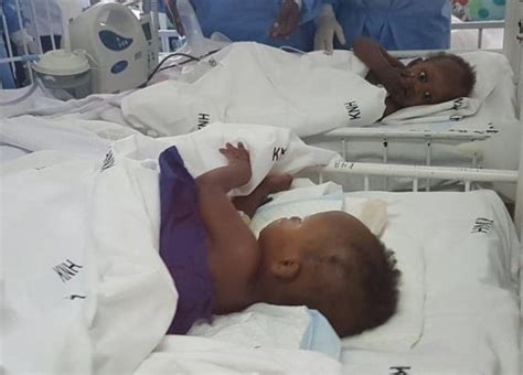 hotandspicygist: Conjoined Twins Meet each Other After Surgery to Separate them