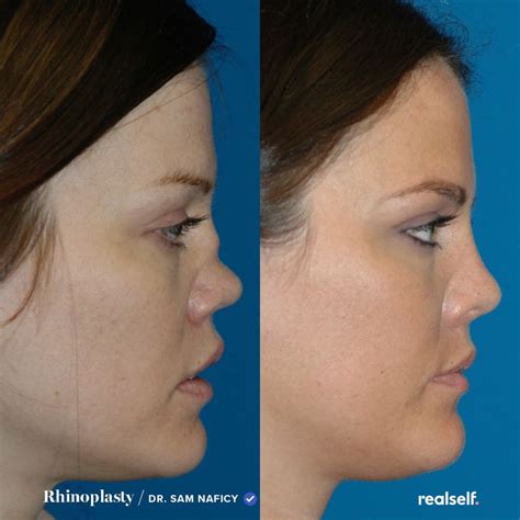 From cost to recovery time. in 2020 Rhinoplasty