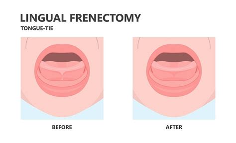 Phoenix Frenectomy Surgery: Frenectomy Procedure