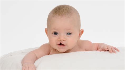 Cleft Lip and Palate Repair | UNIMEDIKS - Improving Facial Harmony