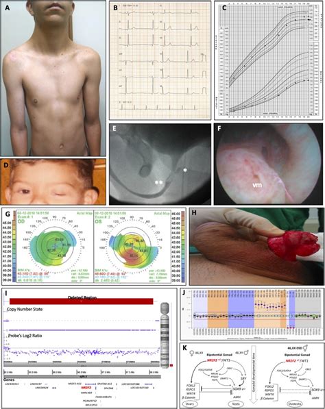 The Natural History of a Man With Ovotesticular 46,XX DSD Caused by a ...