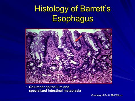 PPT - Barrett’s Esophagus: Clinical aspects, importance & controversies PowerPoint Presentation ...