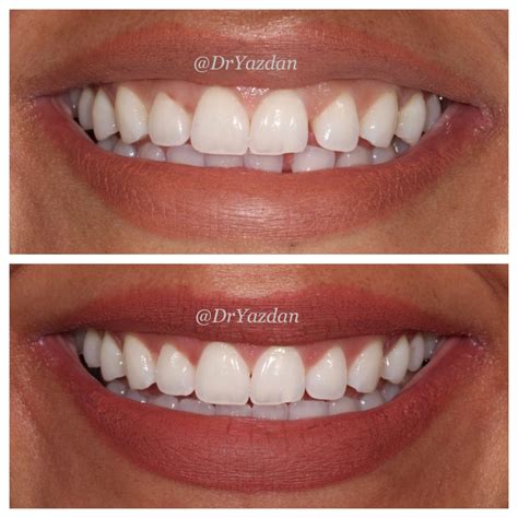 How to Get Straighter Teeth| What is Invisalign for Crooked Teeth ...