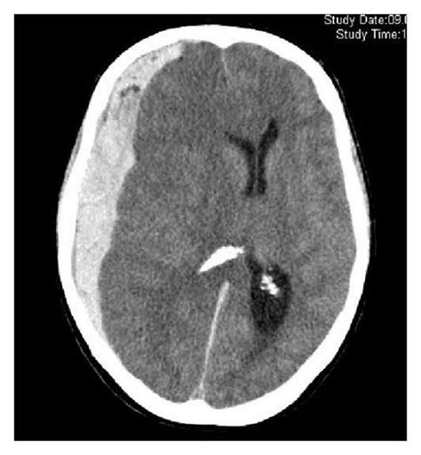 subdural haematoma | Subdural hematoma, Study date, Rn bsn