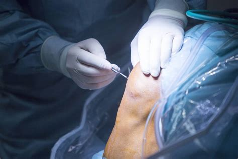 Meniscus Repair 101: Surgery and Recovery | Total Orthocare