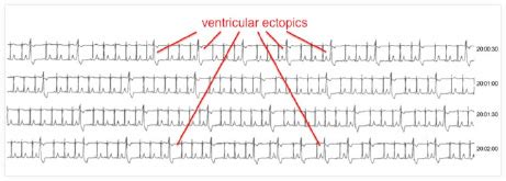 Ectopics or skipped heart beats | Dr Oliver Segal