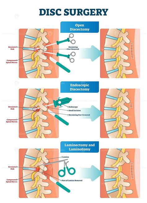 Disc surgery vector illustration - VectorMine