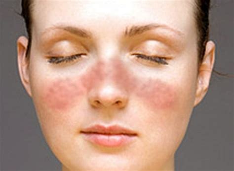 👉 Lupus Rash - Pictures, Symptoms, Causes, Treatment (December 2021)