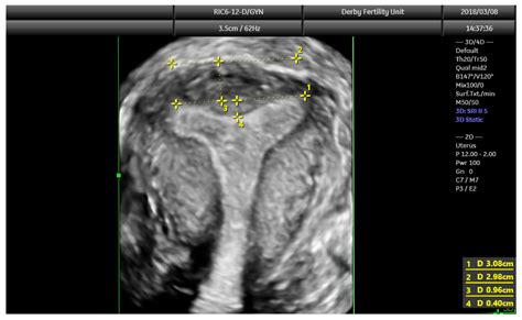 JCM | Free Full-Text | Diagnosis of Congenital Uterine Abnormalities: Practical Considerations