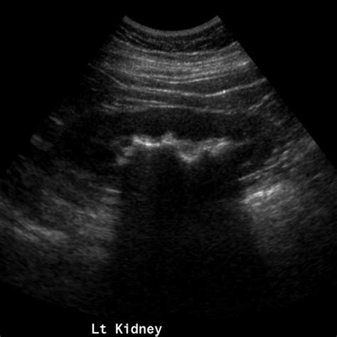 Staghorn calculus | Radiology Case | Radiopaedia.org | Medical ultrasound, Diagnostic imaging ...