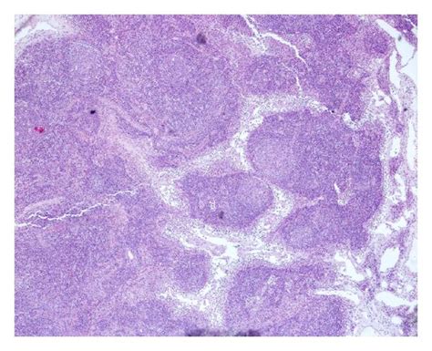 Mediastinal mass biopsy showed reactive lymph nodes presenting ...