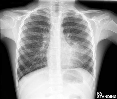 Chest-X-Ray-Images-Pneumonia-/chest-x-ray-images-pneumonia.ipynb at ...