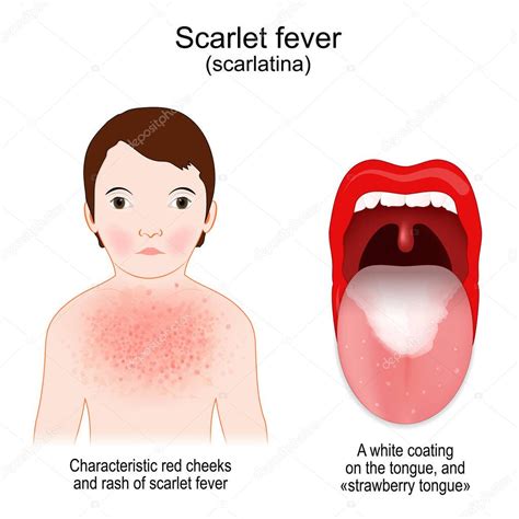 Scarlet fever. Signs and symptoms of Scarlatina. child with rash and ...