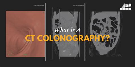 What Is A CT Colonography? — Bay Imaging Consultants