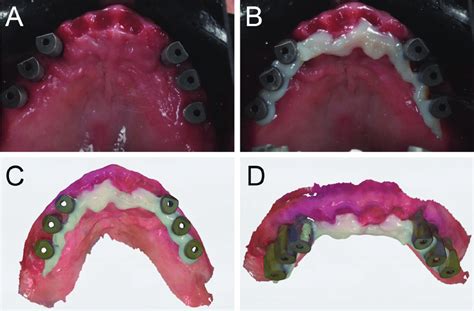 Fully edentulous patient with six implants in the maxilla. (A) The SBs... | Download Scientific ...