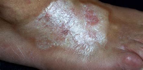 localized scleroderma - pictures, photos